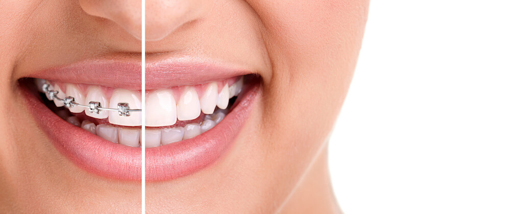 Invisalign Advantages vs Traditional Braces. What's the Better